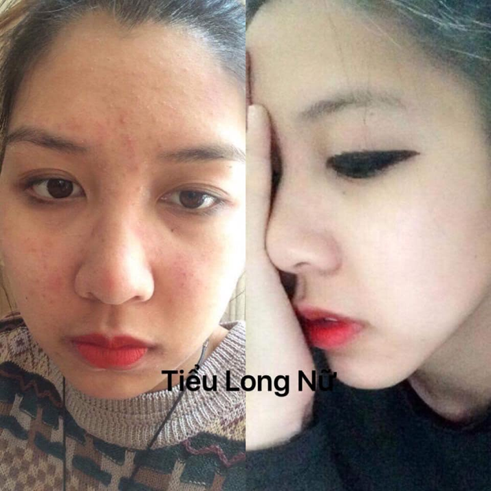 Trị mụn lohabeauty